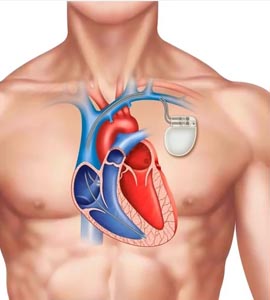 pacemaker-implantation